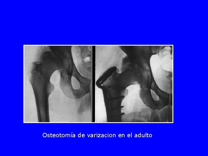 Osteotomía de varizacion en el adulto 
