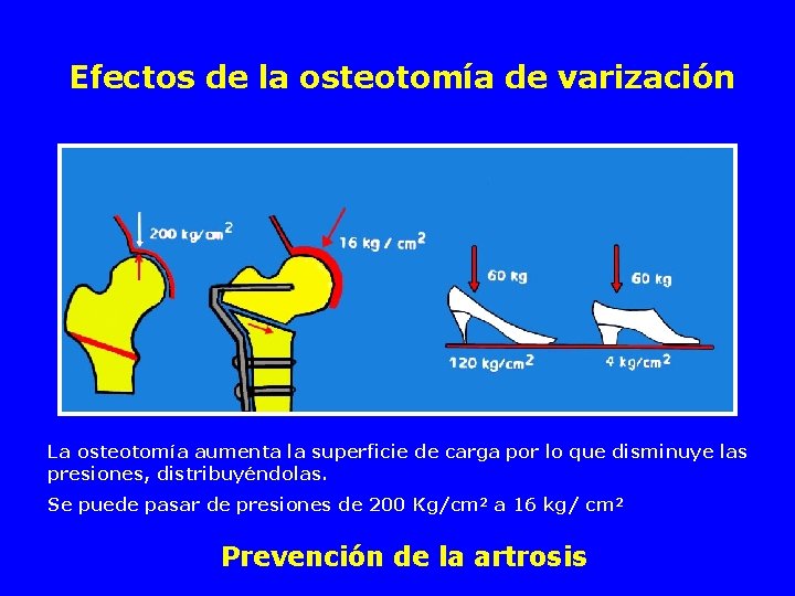 Efectos de la osteotomía de varización La osteotomía aumenta la superficie de carga por