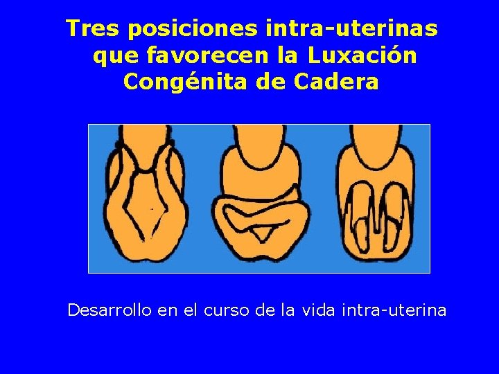 Tres posiciones intra-uterinas que favorecen la Luxación Congénita de Cadera Desarrollo en el curso