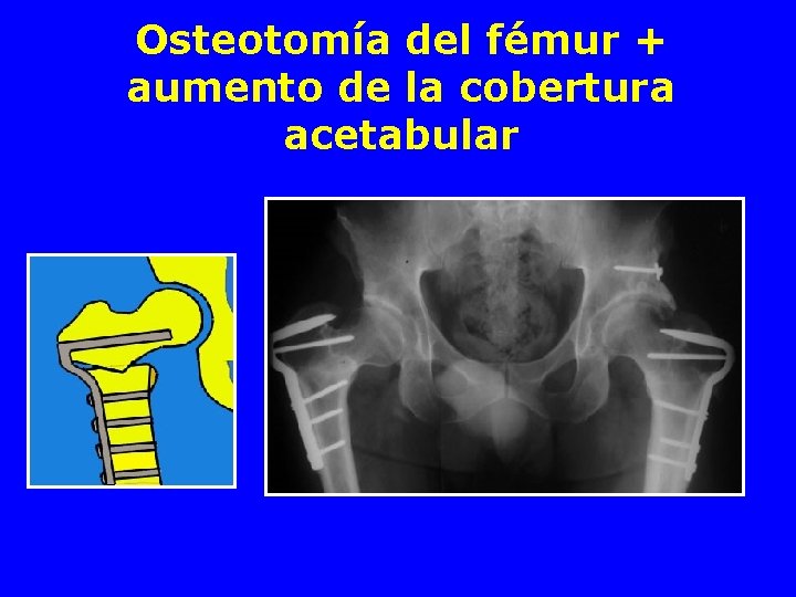 Osteotomía del fémur + aumento de la cobertura acetabular 