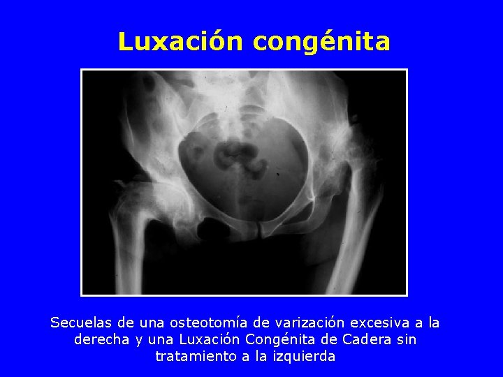 Luxación congénita Secuelas de una osteotomía de varización excesiva a la derecha y una