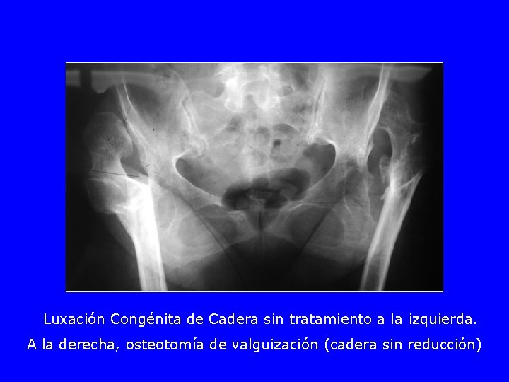 Luxación Congénita de Cadera sin tratamiento a la izquierda. A la derecha, osteotomía de