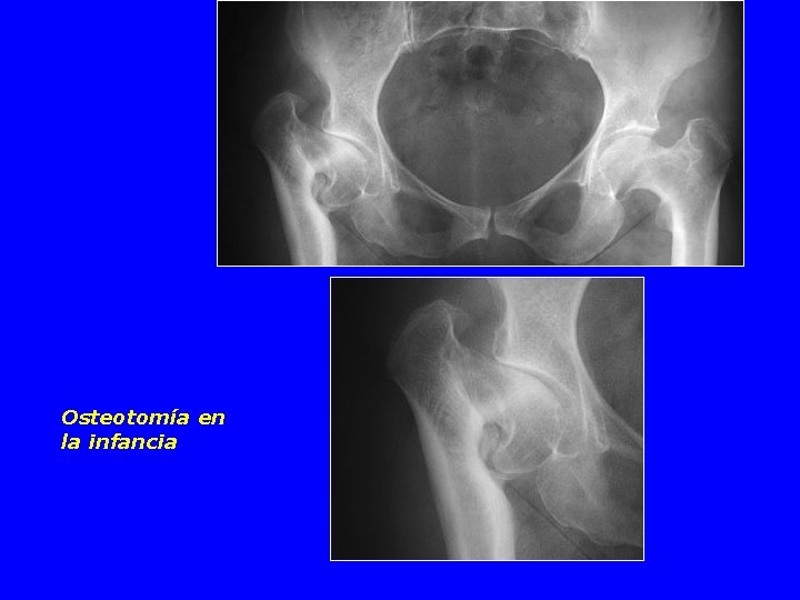 Osteotomía en la infancia 