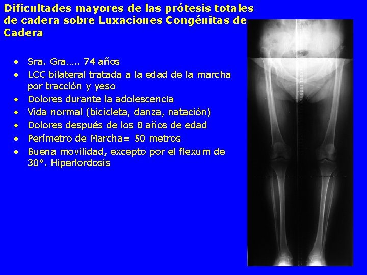Dificultades mayores de las prótesis totales de cadera sobre Luxaciones Congénitas de Cadera •