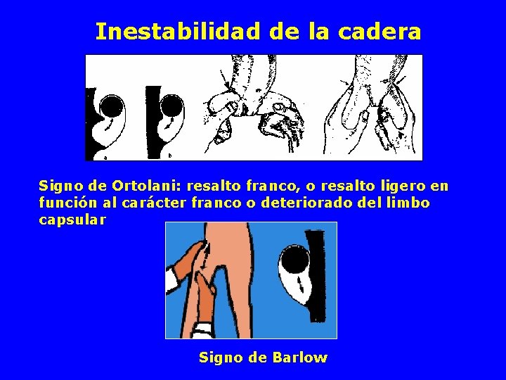 Inestabilidad de la cadera Signo de Ortolani: resalto franco, o resalto ligero en función