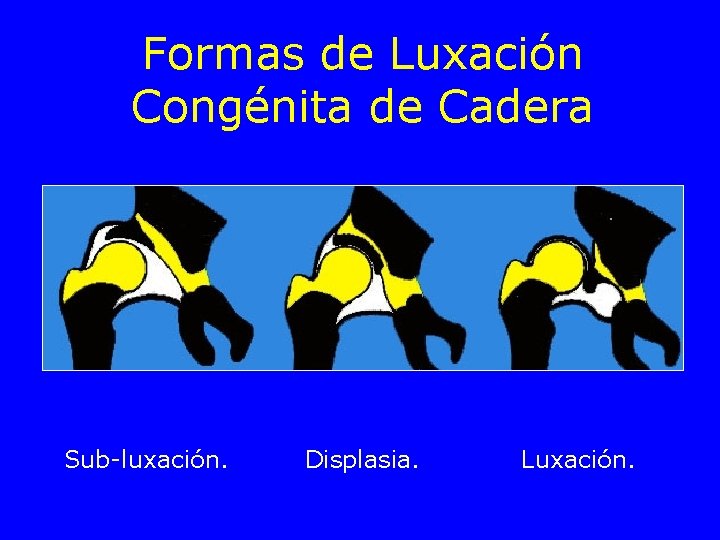 Formas de Luxación Congénita de Cadera Sub-luxación. Displasia. Luxación. 