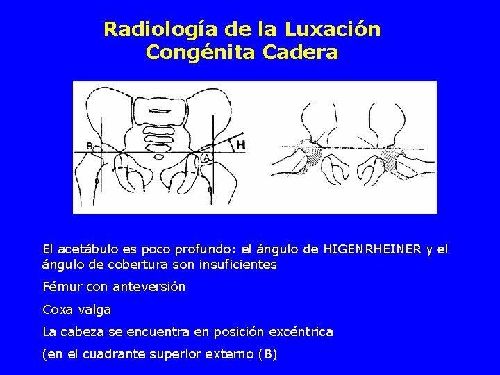 Radiología de la Luxación Congénita Cadera El acetábulo es poco profundo: el ángulo de