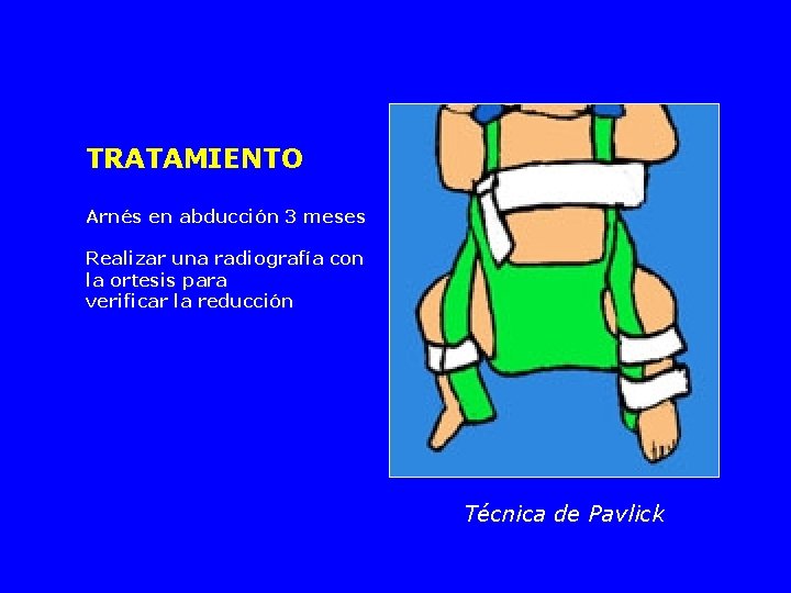TRATAMIENTO Arnés en abducción 3 meses Realizar una radiografía con la ortesis para verificar