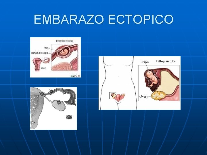 EMBARAZO ECTOPICO EMBARAZO ECTOPICO