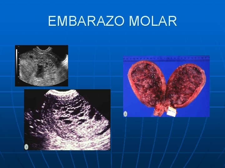 EMBARAZO MOLAR EMBARAZO MOLAR