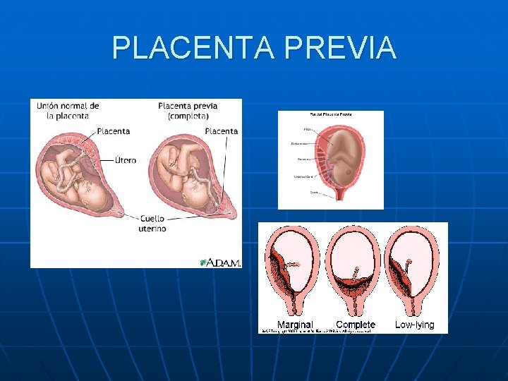 PLACENTA PREVIA PLACENTA PREVIA