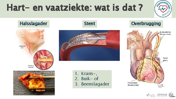 Hart- en vaatziekte: wat is dat ? Halsslagader Stent 1. Krans-, 2. Buik- of
