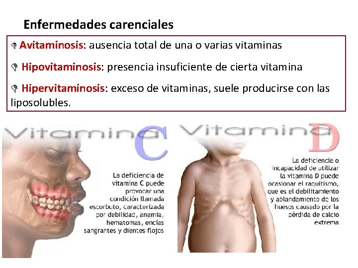 Enfermedades carenciales Avitaminosis: ausencia total de una o varias vitaminas Hipovitaminosis: presencia insuficiente de