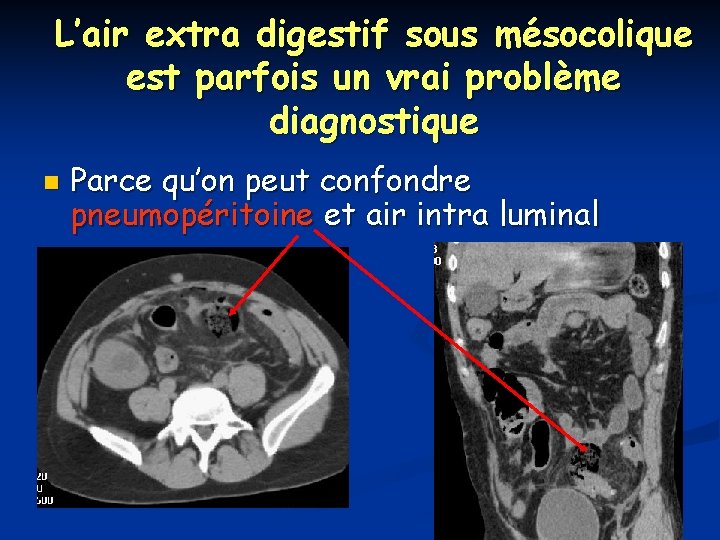 L’air extra digestif sous mésocolique est parfois un vrai problème diagnostique n Parce qu’on