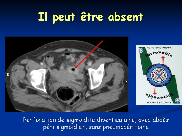 Il peut être absent Perforation de sigmoïdite diverticulaire, avec abcès péri sigmoïdien, sans pneumopéritoine