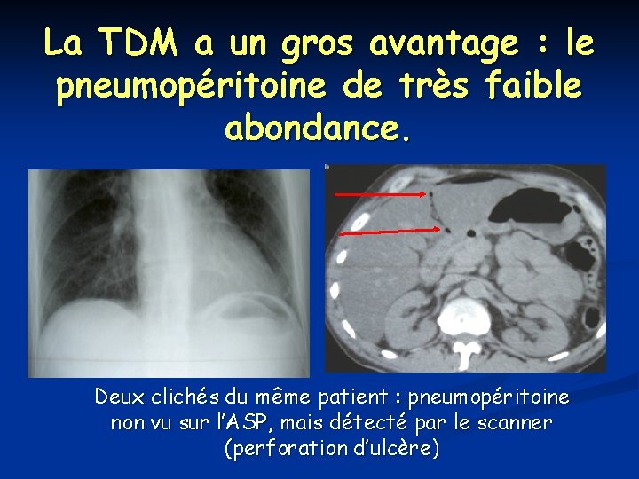 La TDM a un gros avantage : le pneumopéritoine de très faible abondance. Deux