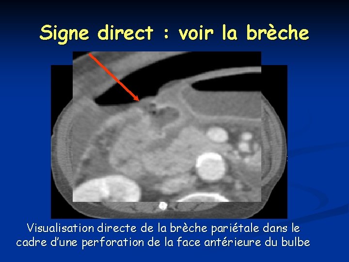 Signe direct : voir la brèche Visualisation directe de la brèche pariétale dans le