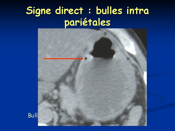 Signe direct : bulles intra pariétales Bulle d’air intra pariétale (perforation d’ulcère gastrique) 