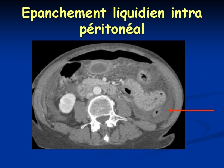 Epanchement liquidien intra péritonéal 