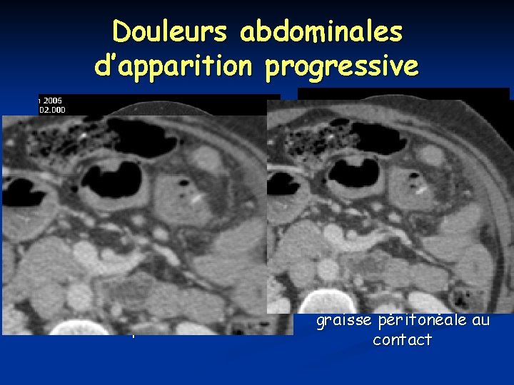 Douleurs abdominales d’apparition progressive Perforation du grêle par un os de poulet Densification de