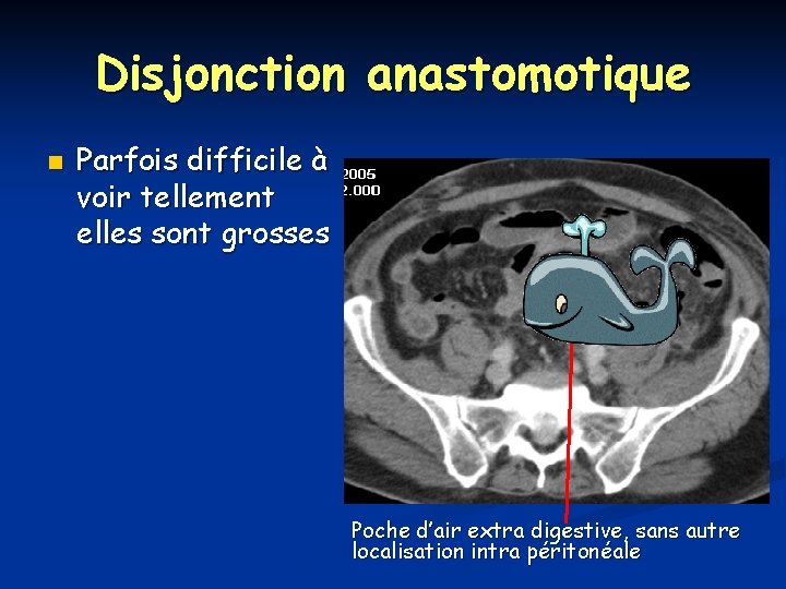 Disjonction anastomotique n Parfois difficile à voir tellement elles sont grosses Poche d’air extra