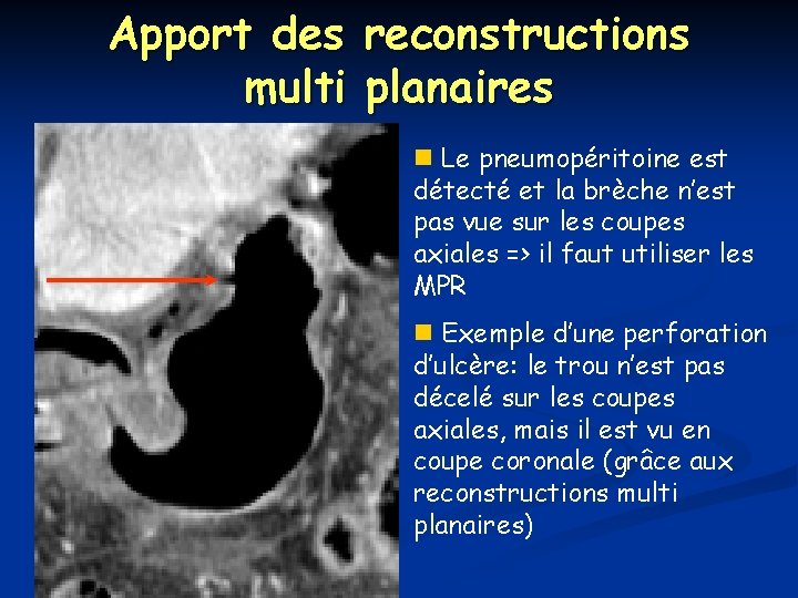 Apport des reconstructions multi planaires n Le pneumopéritoine est détecté et la brèche n’est