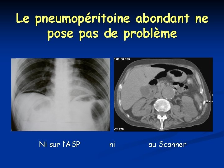 Le pneumopéritoine abondant ne pose pas de problème Ni sur l’ASP ni au Scanner