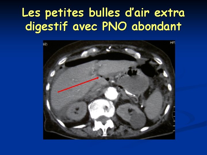 Les petites bulles d’air extra digestif avec PNO abondant 