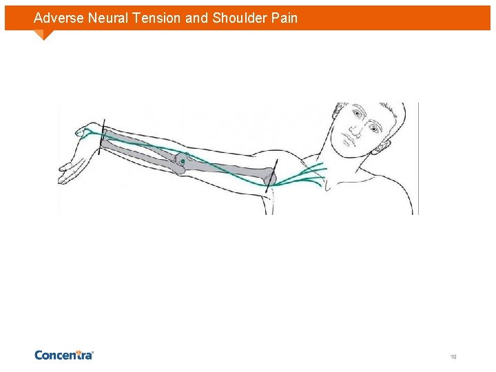 Adverse Neural Tension and Shoulder Pain 19 