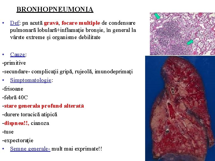 BRONHOPNEUMONIA • Def: pn acută gravă, focare multiple de condensare pulmonară lobulară+inflamaţie bronşie, în