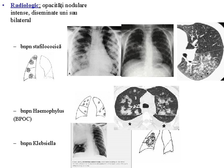  • Radiologic: opacităţi nodulare intense, diseminate uni sau bilateral – bnpn stafilococică –