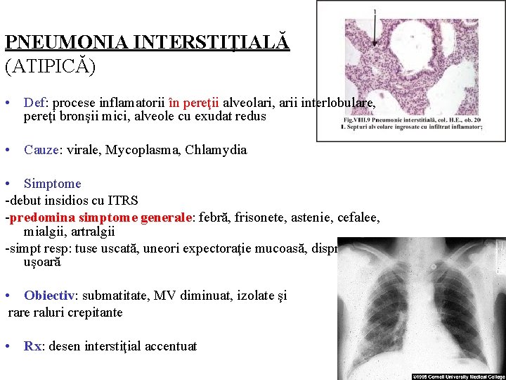 PNEUMONIA INTERSTIŢIALĂ (ATIPICĂ) • Def: procese inflamatorii în pereţii alveolari, arii interlobulare, pereţi bronşii