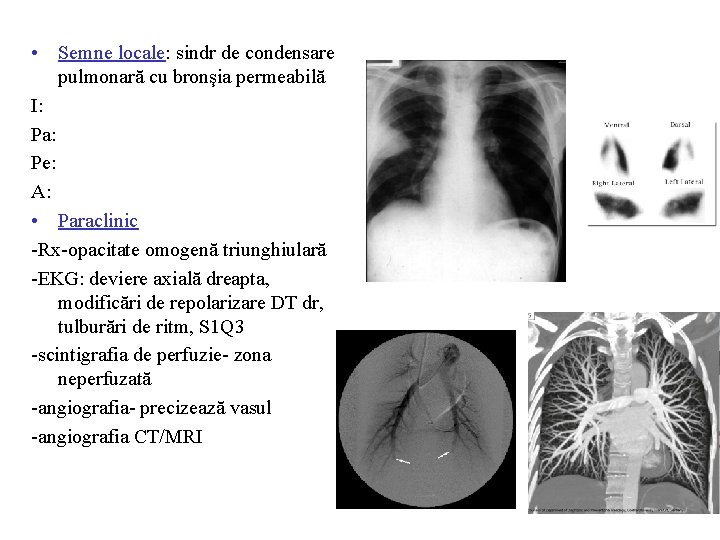  • Semne locale: sindr de condensare pulmonară cu bronşia permeabilă I: Pa: Pe: