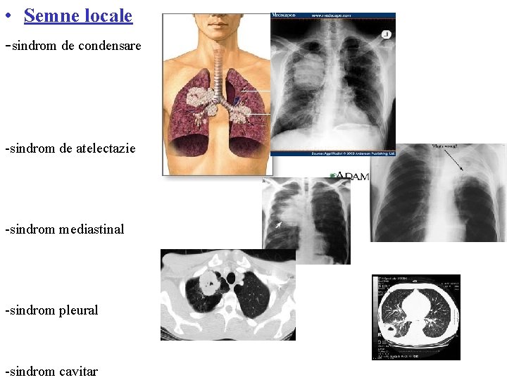  • Semne locale -sindrom de condensare -sindrom de atelectazie -sindrom mediastinal -sindrom pleural