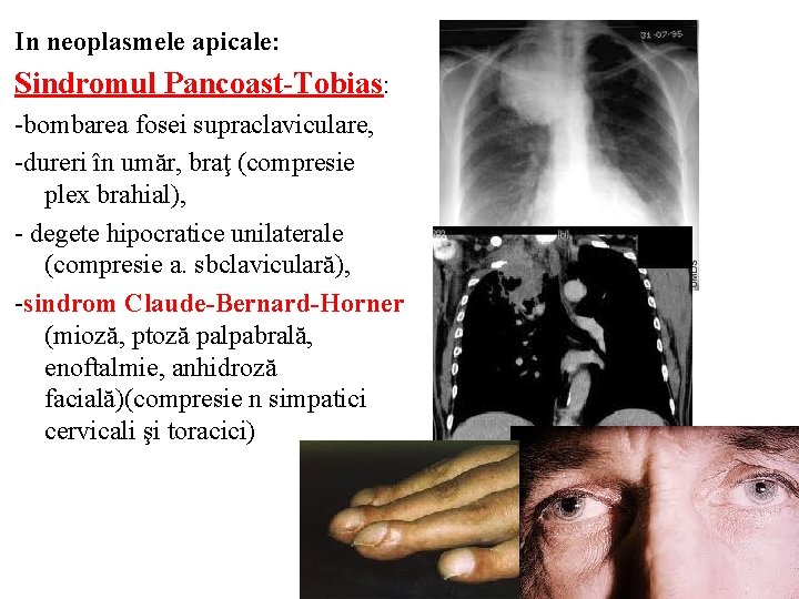 In neoplasmele apicale: Sindromul Pancoast-Tobias: -bombarea fosei supraclaviculare, -dureri în umăr, braţ (compresie plex