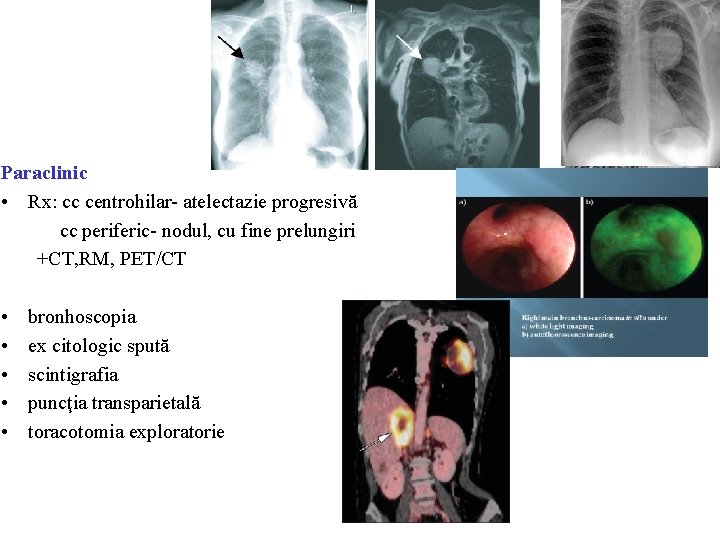 Paraclinic • Rx: cc centrohilar- atelectazie progresivă cc periferic- nodul, cu fine prelungiri +CT,