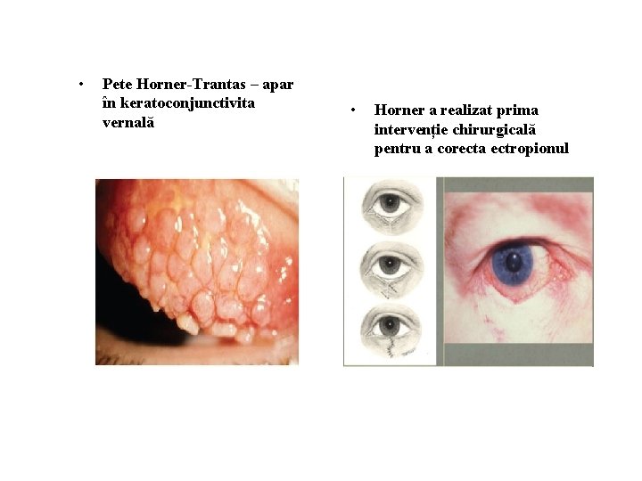  • Pete Horner-Trantas – apar în keratoconjunctivita vernală • Horner a realizat prima