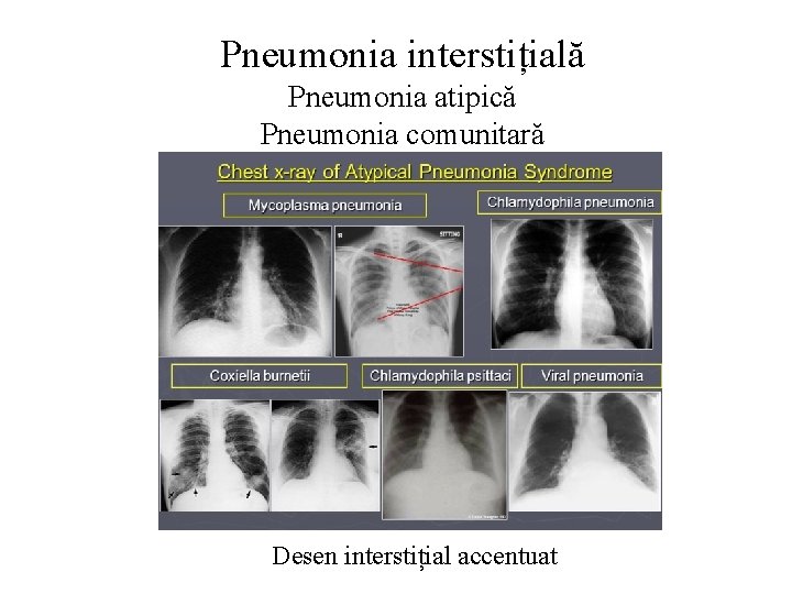 Pneumonia interstițială Pneumonia atipică Pneumonia comunitară Desen interstițial accentuat 