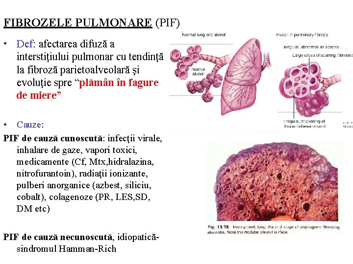 FIBROZELE PULMONARE (PIF) • Def: afectarea difuză a interstiţiului pulmonar cu tendinţă la fibroză