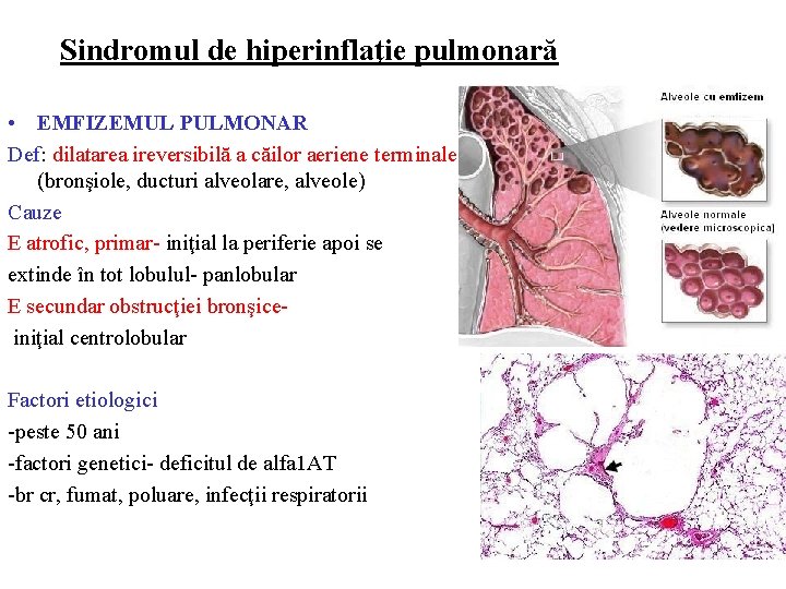 Sindromul de hiperinflaţie pulmonară • EMFIZEMUL PULMONAR Def: dilatarea ireversibilă a căilor aeriene terminale