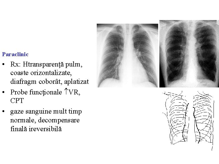 Paraclinic • Rx: Htransparenţă pulm, coaste orizontalizate, diafragm coborât, aplatizat • Probe funcţionale VR,