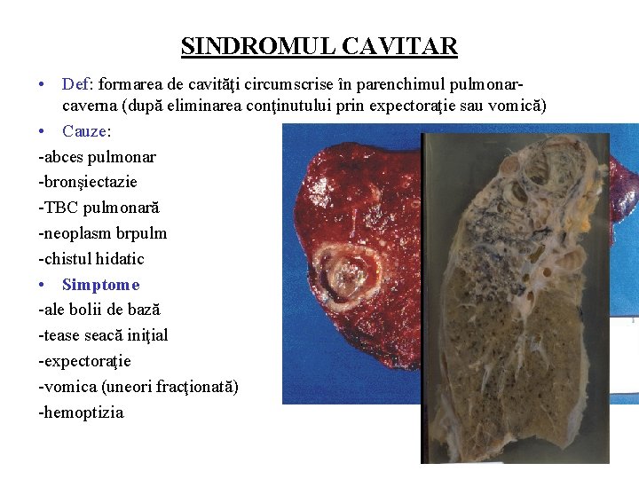 SINDROMUL CAVITAR • Def: formarea de cavităţi circumscrise în parenchimul pulmonar- caverna (după eliminarea