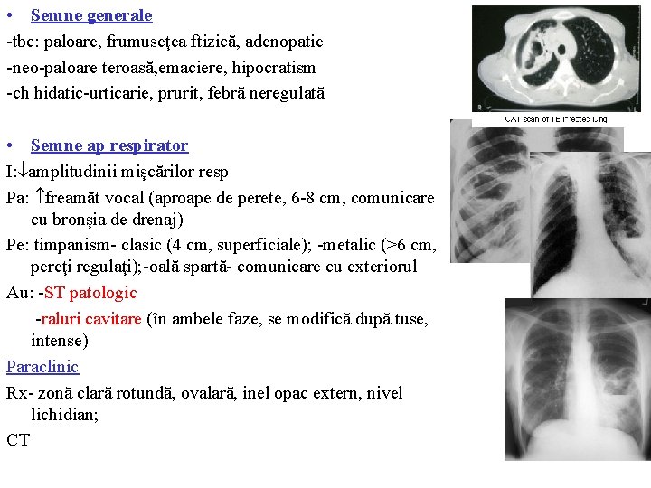  • Semne generale -tbc: paloare, frumuseţea ftizică, adenopatie -neo-paloare teroasă, emaciere, hipocratism -ch