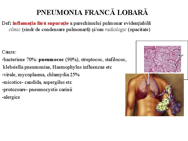 PNEUMONIA FRANCĂ LOBARĂ Def: inflamaţia fără supuraţie a parechimului pulmonar evidenţiabilă clinic (sindr de