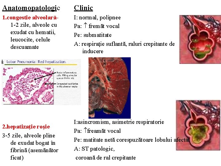 Anatomopatologic Clinic 1. congestie alveolară- 1 -2 zile, alveole cu exudat cu hematii, leucocite,