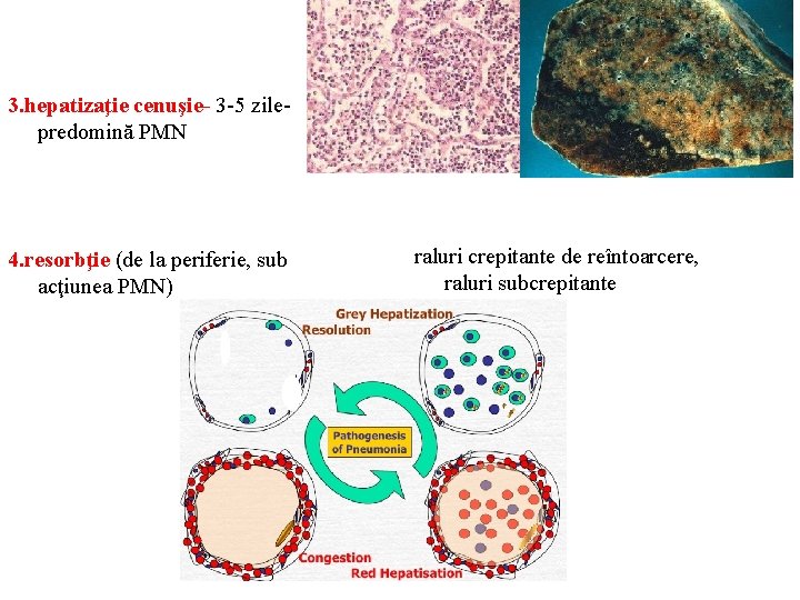 3. hepatizaţie cenuşie- 3 -5 zile- predomină PMN 4. resorbţie (de la periferie, sub