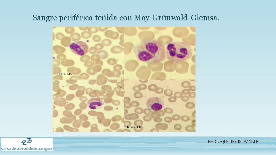 Sangre periférica teñida con May-Grünwald-Giemsa. EHDL. /QFB. IRAIS IPATZI R. 