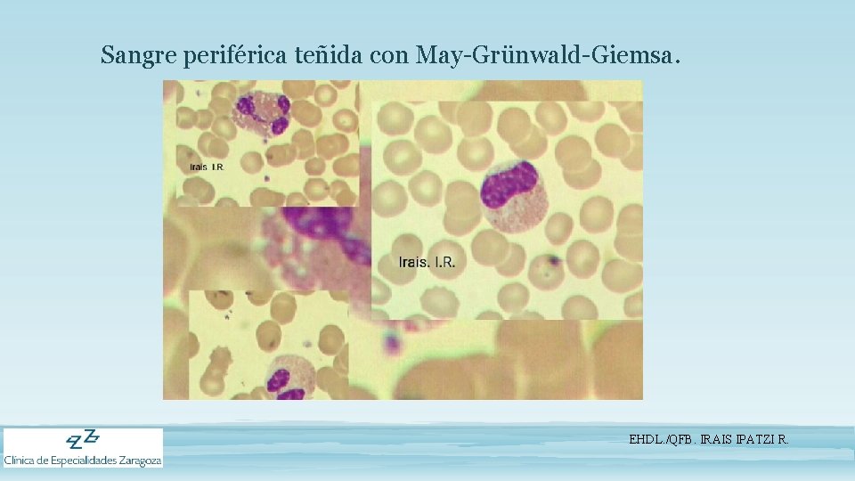 Sangre periférica teñida con May-Grünwald-Giemsa. EHDL. /QFB. IRAIS IPATZI R. 