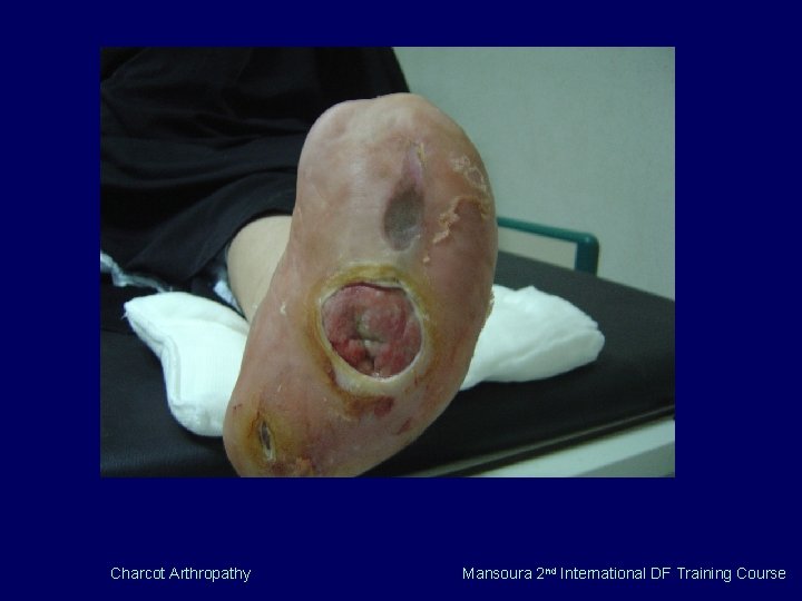 Charcot Arthropathy Mansoura 2 nd International DF Training Course 