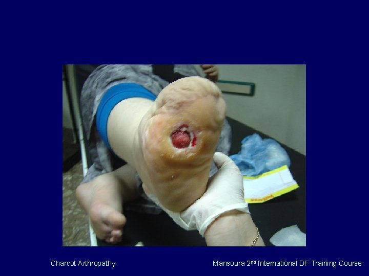 Charcot Arthropathy Mansoura 2 nd International DF Training Course 